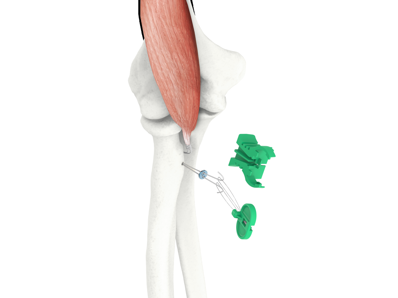 supinX distal biceps repair model