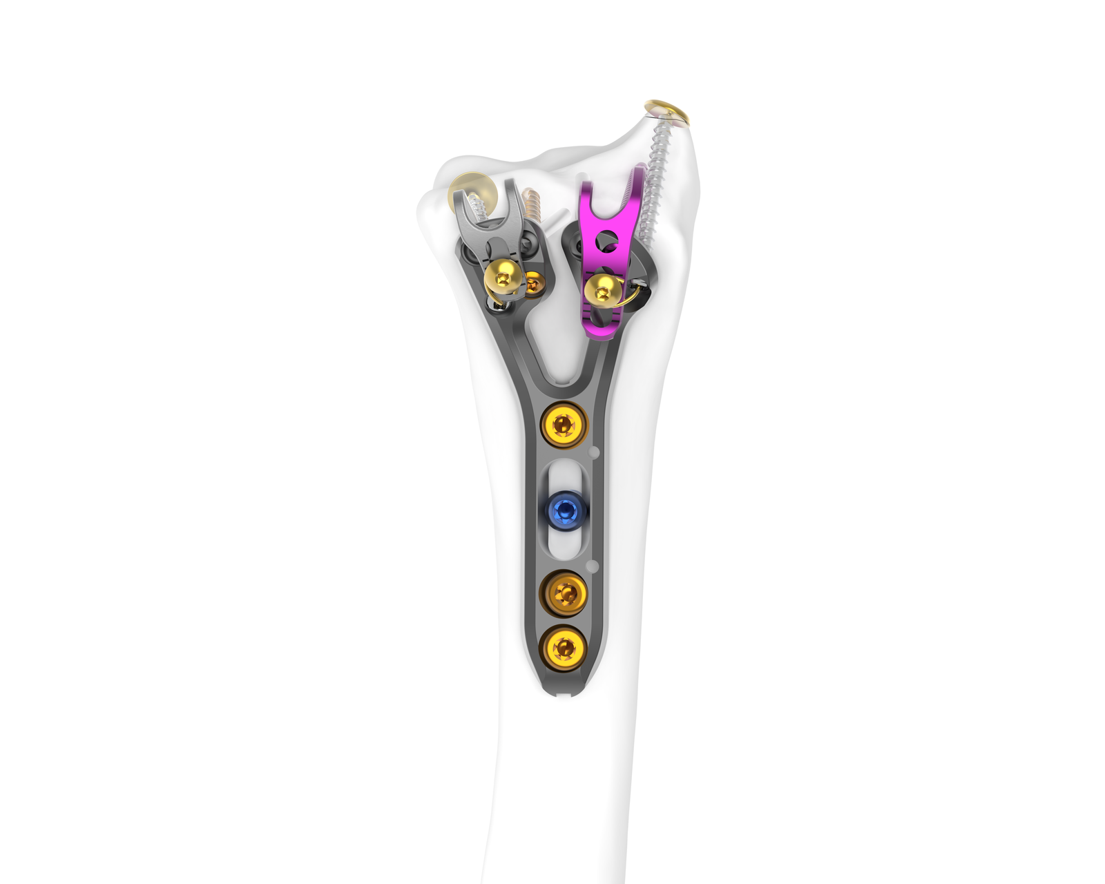 GEMINUS V2 FREEFIX frontal construct