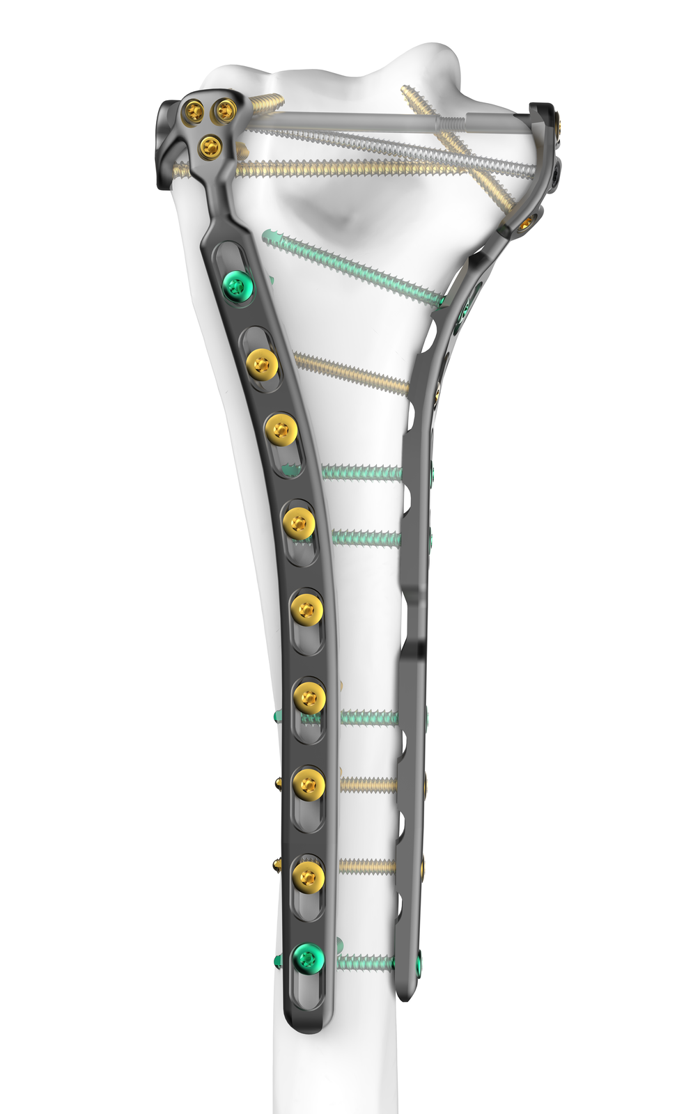 FREEFIX Humeral Fixation Set lateral construct