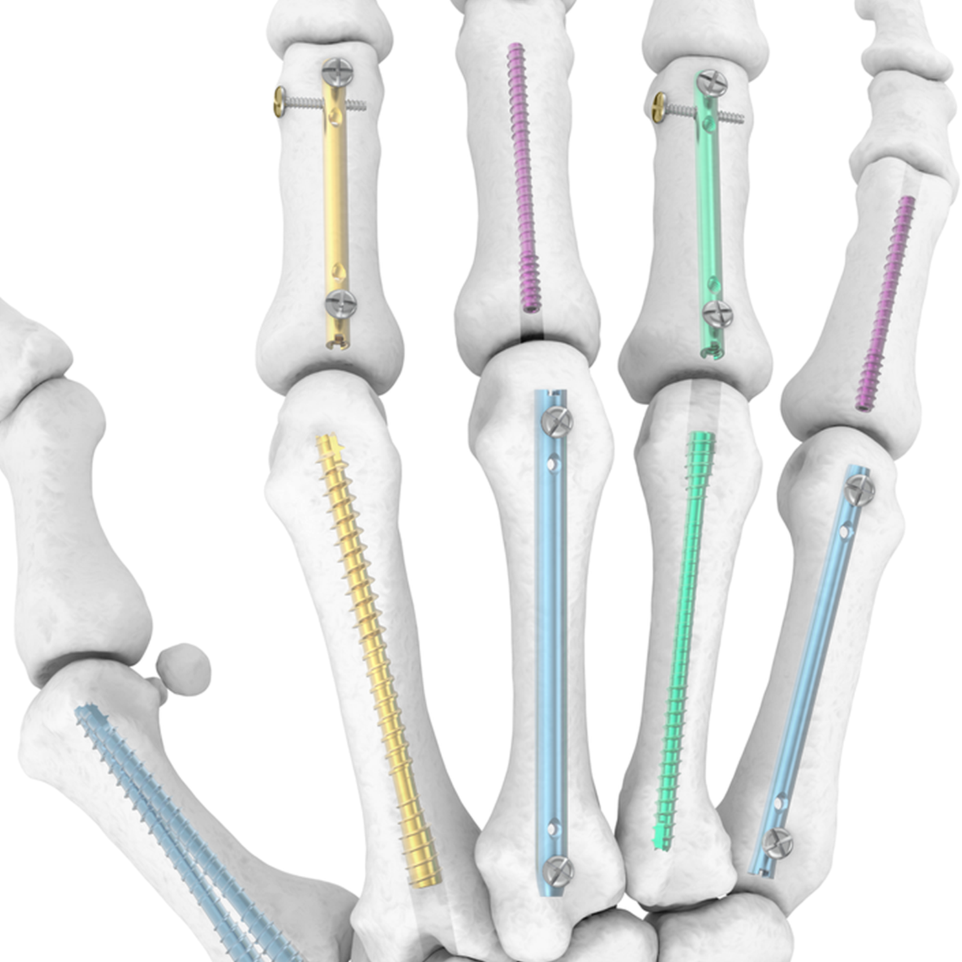 Hand Nailing Set construct on bone