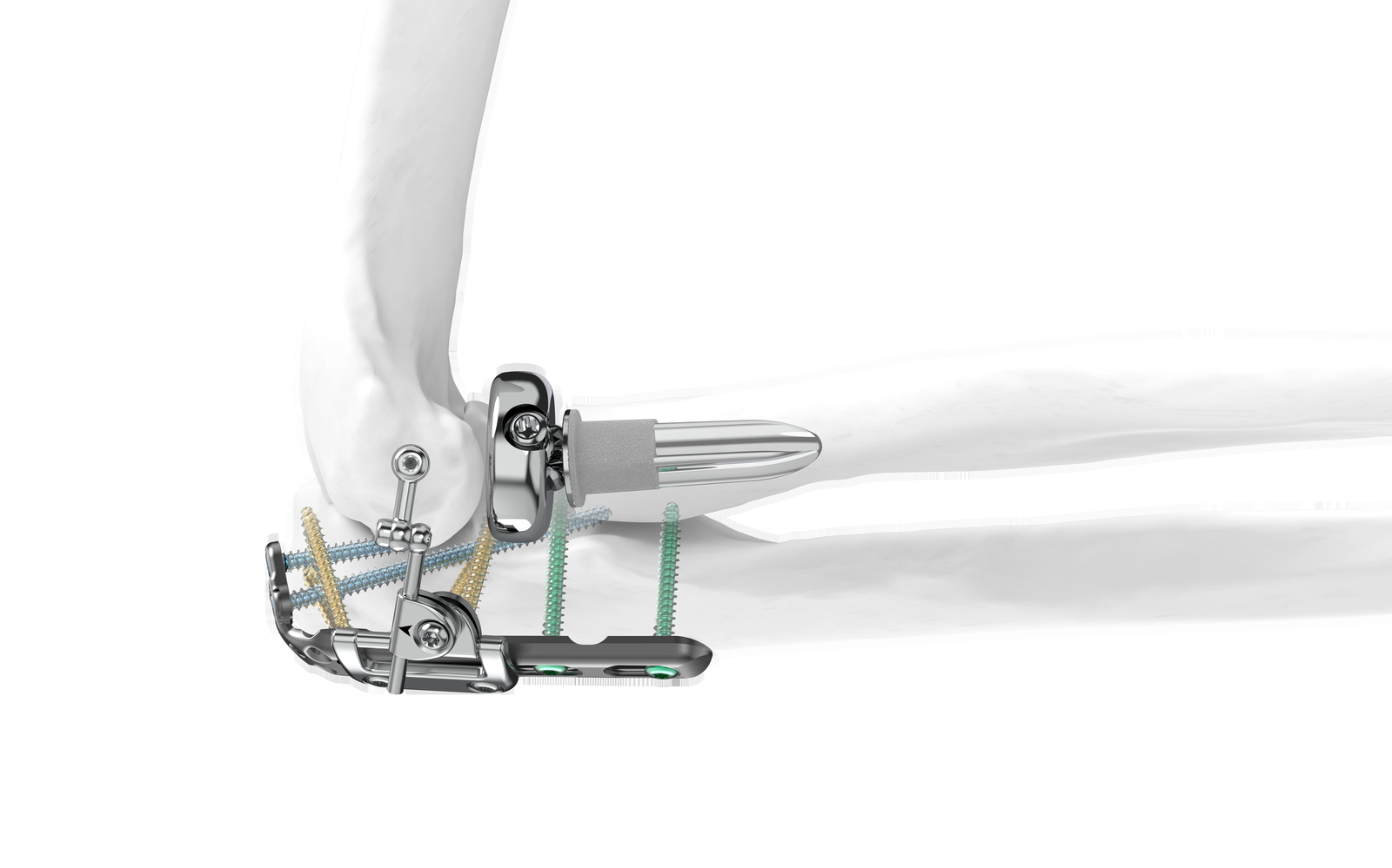 Skeletal Dynamics distal elbow construct — ALIGN radial head, Proximal Ulna Plate and IJS Elbow on bone