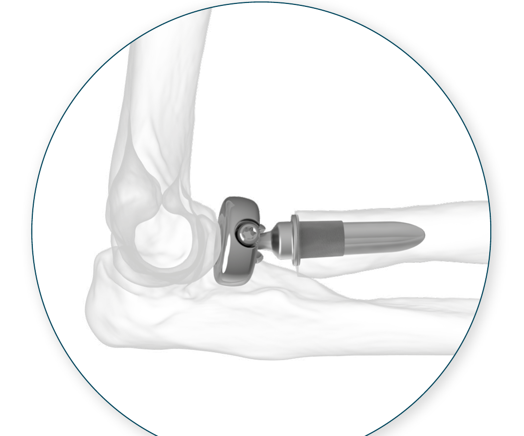 ALIGN Radial Head