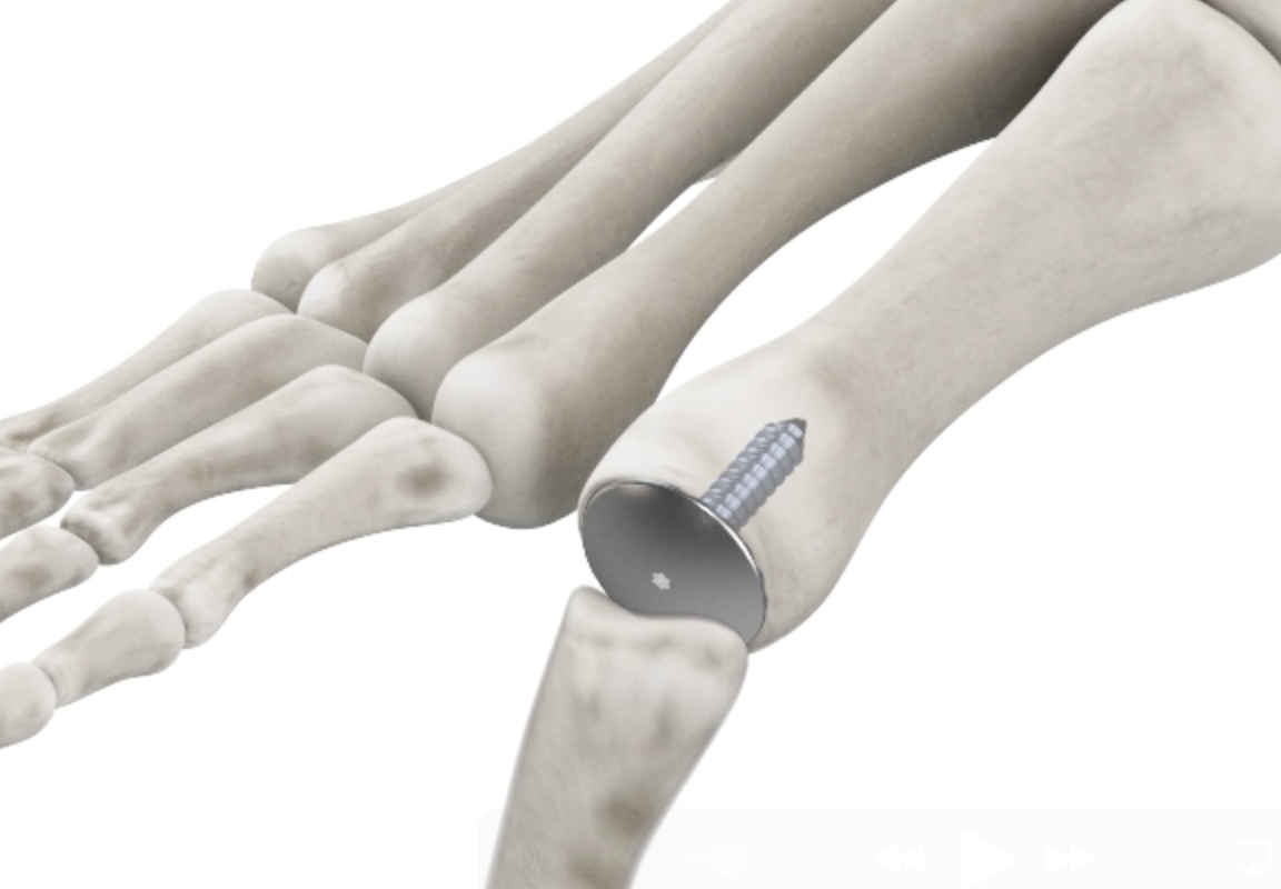 AccuJoint cemented MTP hemi implant seated in the joint.