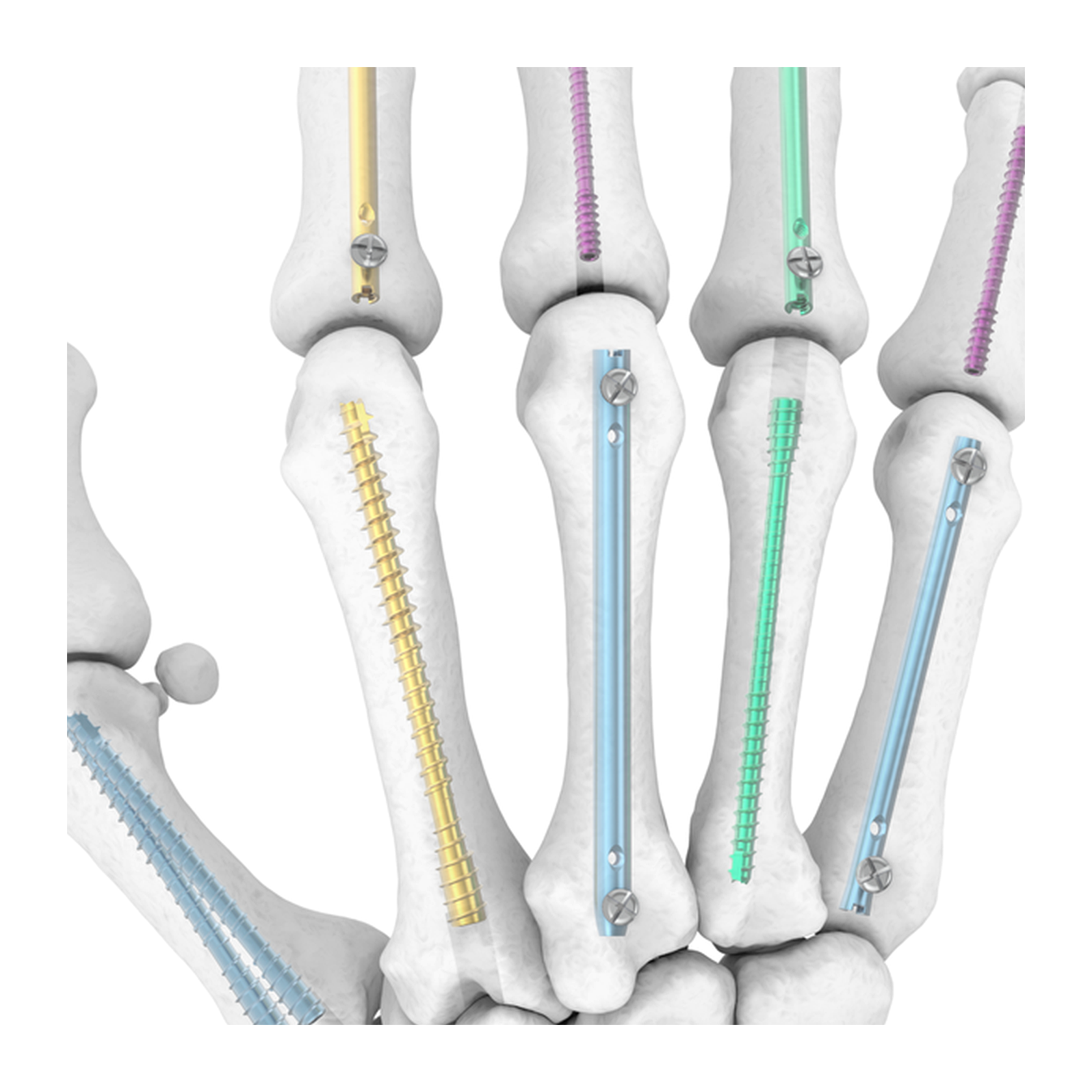 Skeletal Dynamics Locking Hand Nail