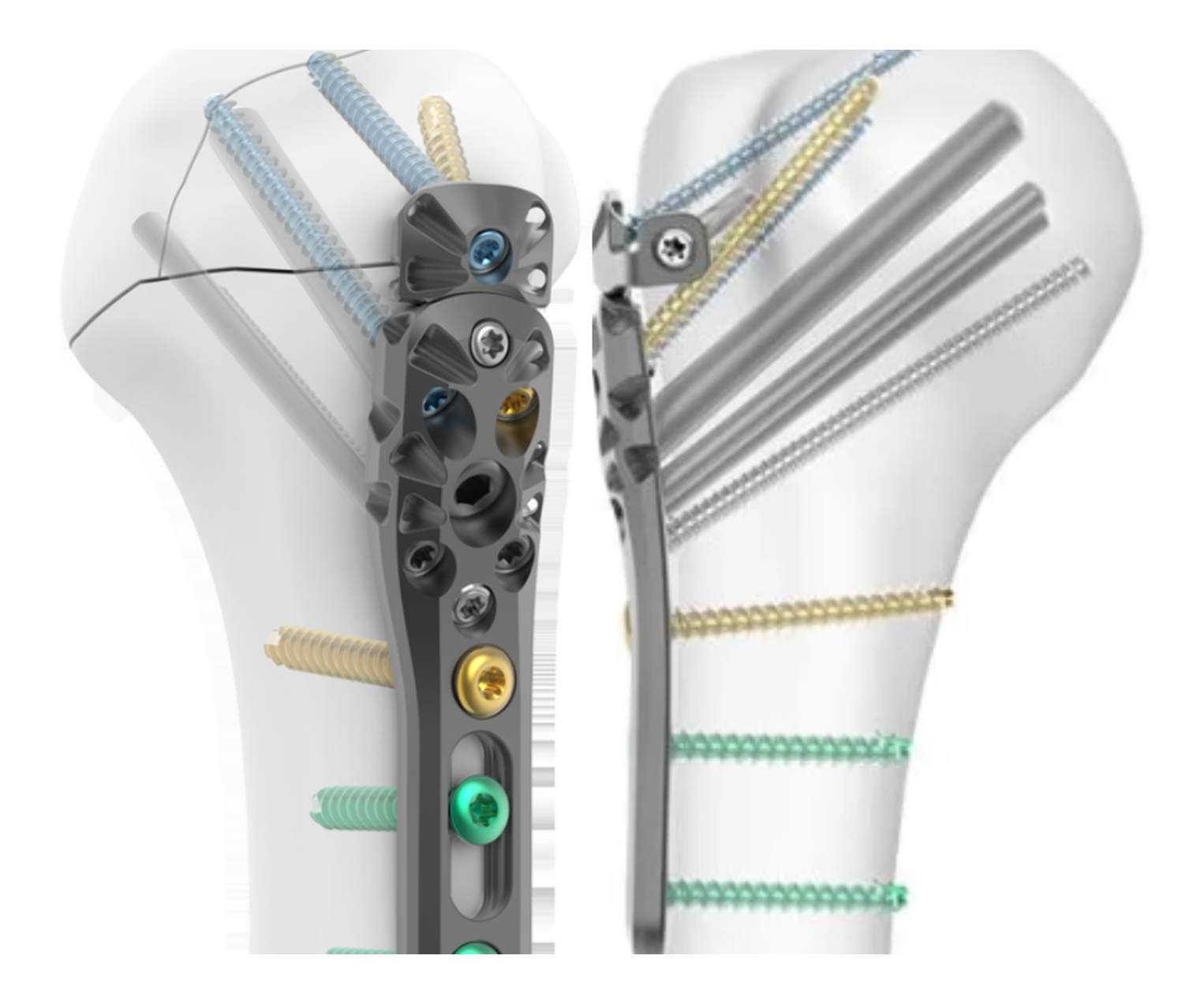 Skeletal Dynamics PHP Construct — oblique and head-on views
