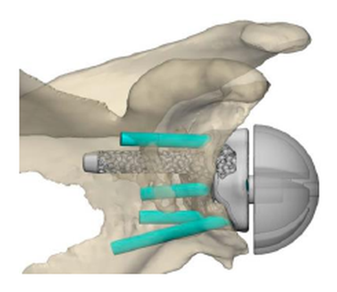 restor3d Custom Glenoid