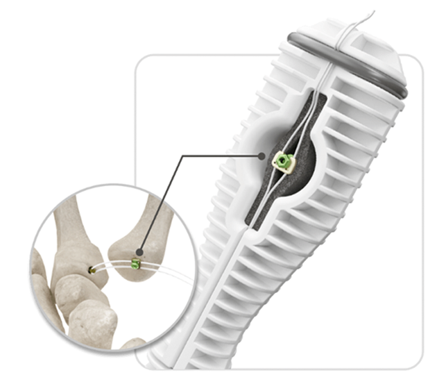 Simparo Surgical · Anchor Line