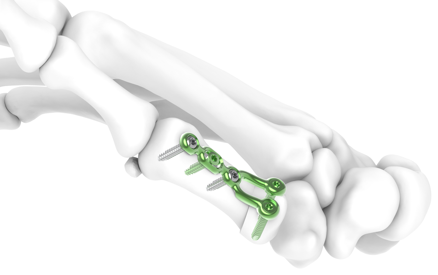 CMC Osteotomy Plate — Skeletal Dynamics