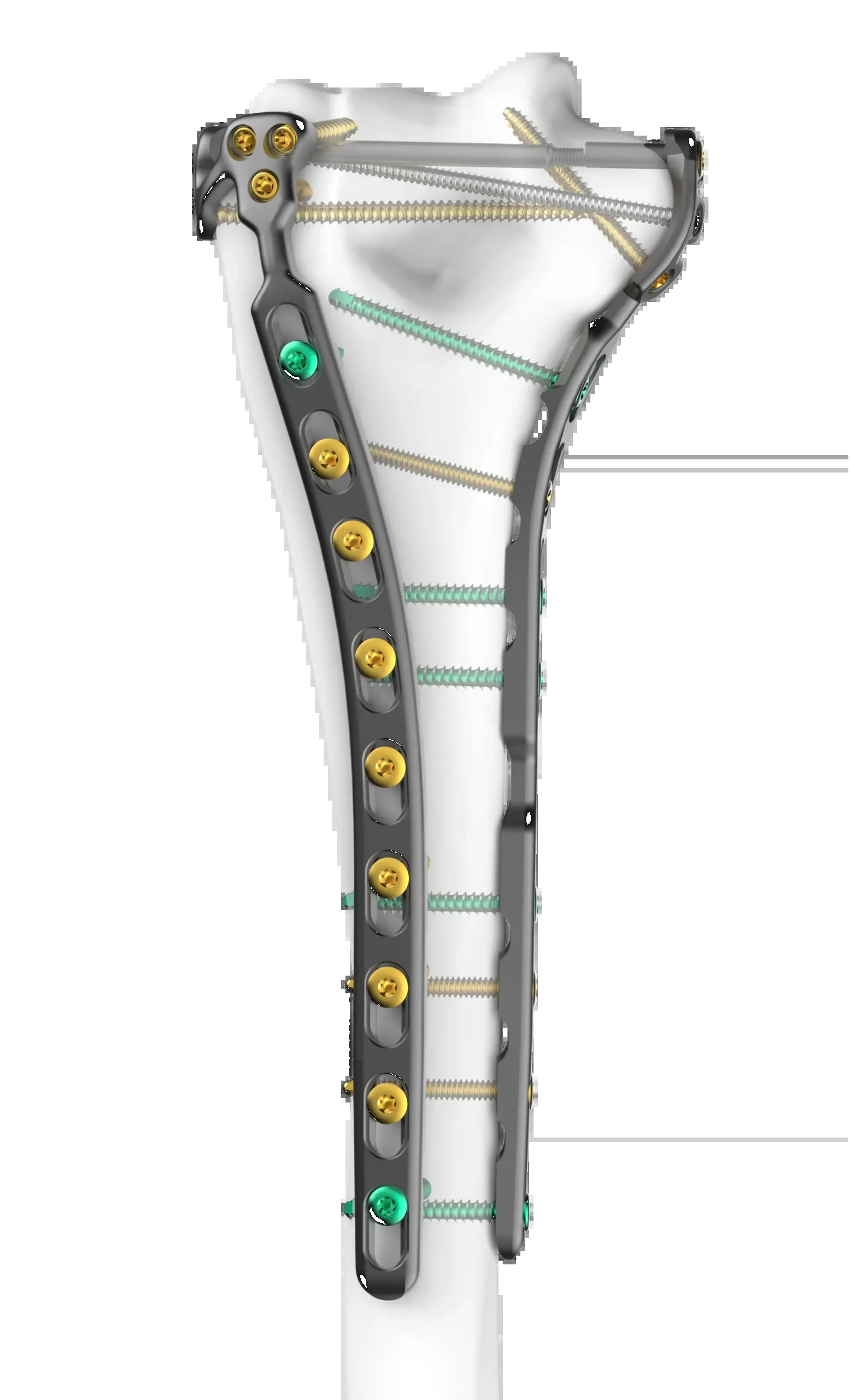 Distal Humerus