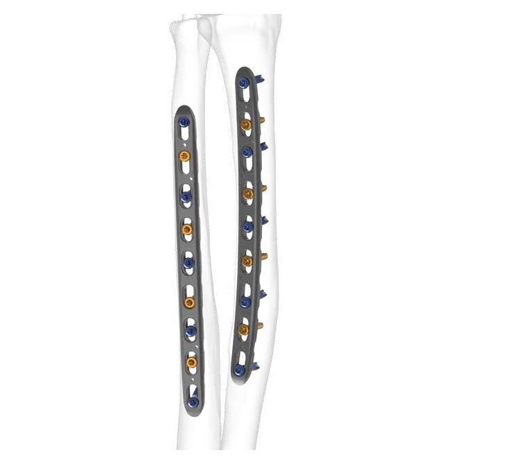 Skeletal Dynamics FREEFIX forearm plates on radius and ulna