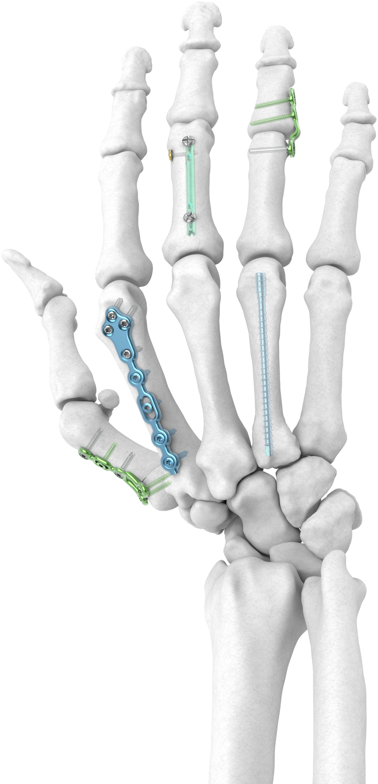 Hand Trauma pack constructs — Skeletal Dynamics