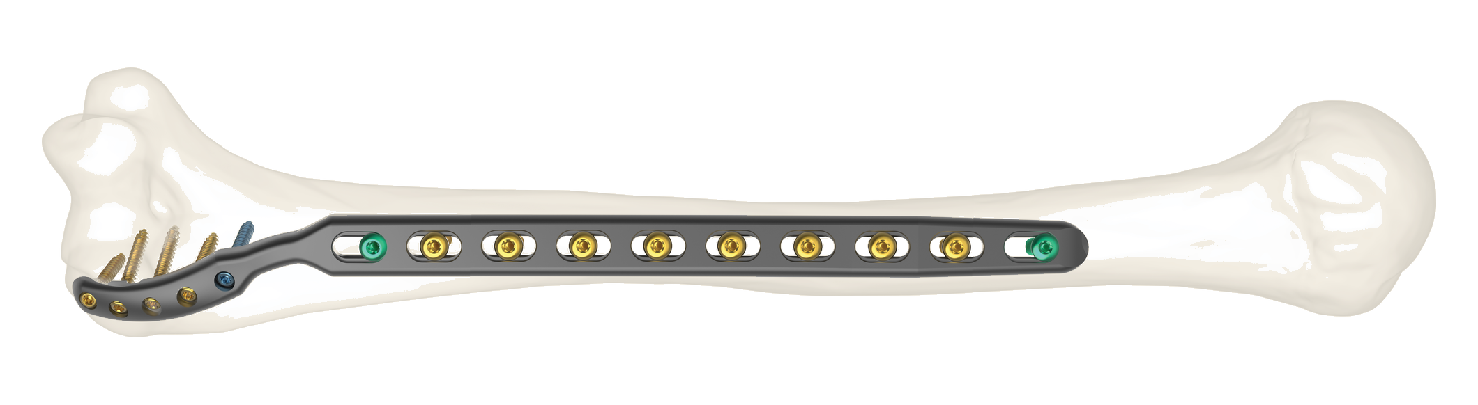 Skeletal Dynamics FREEFIX supracondylar humerus plate on bone
