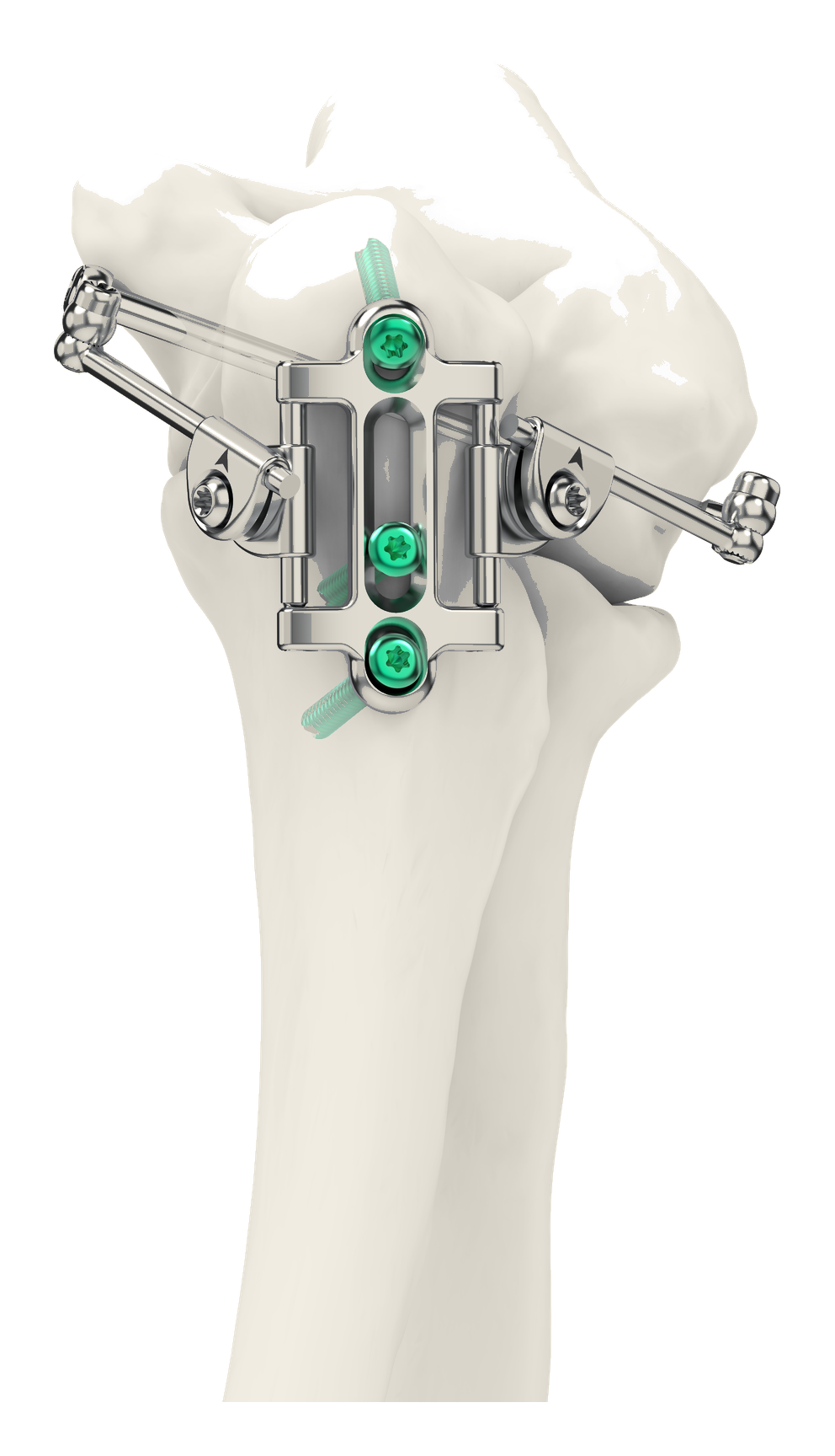 Skeletal Dynamics IJS Elbow — medial and lateral stabilizers on bone