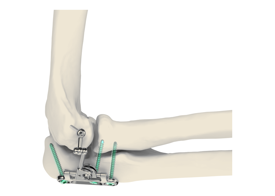 IJS Elbow on white bone construct