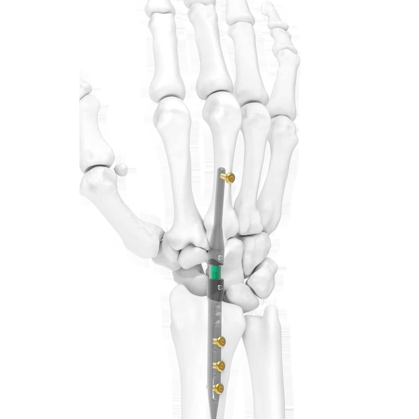 IMPLATE LEDA wrist arthrodesis construct — Skeletal Dynamics