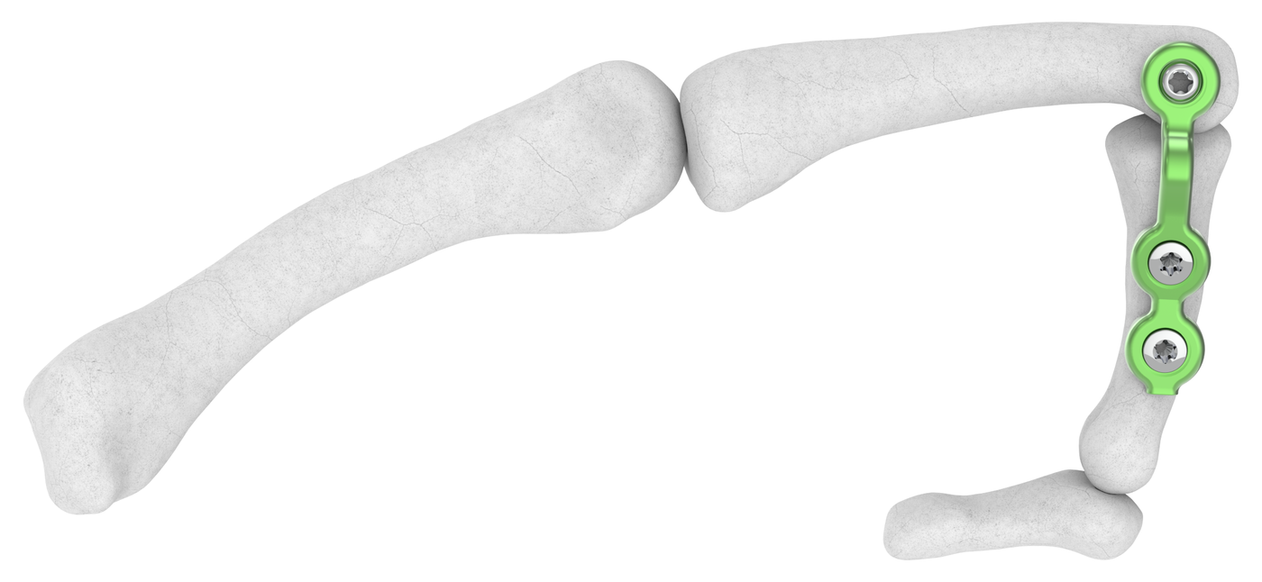 Phalanx Stabilization Plate construct on bone — Skeletal Dynamics