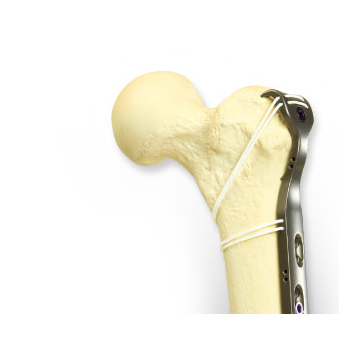 Kinamed SuperCable cerclage around a femur model with a plate