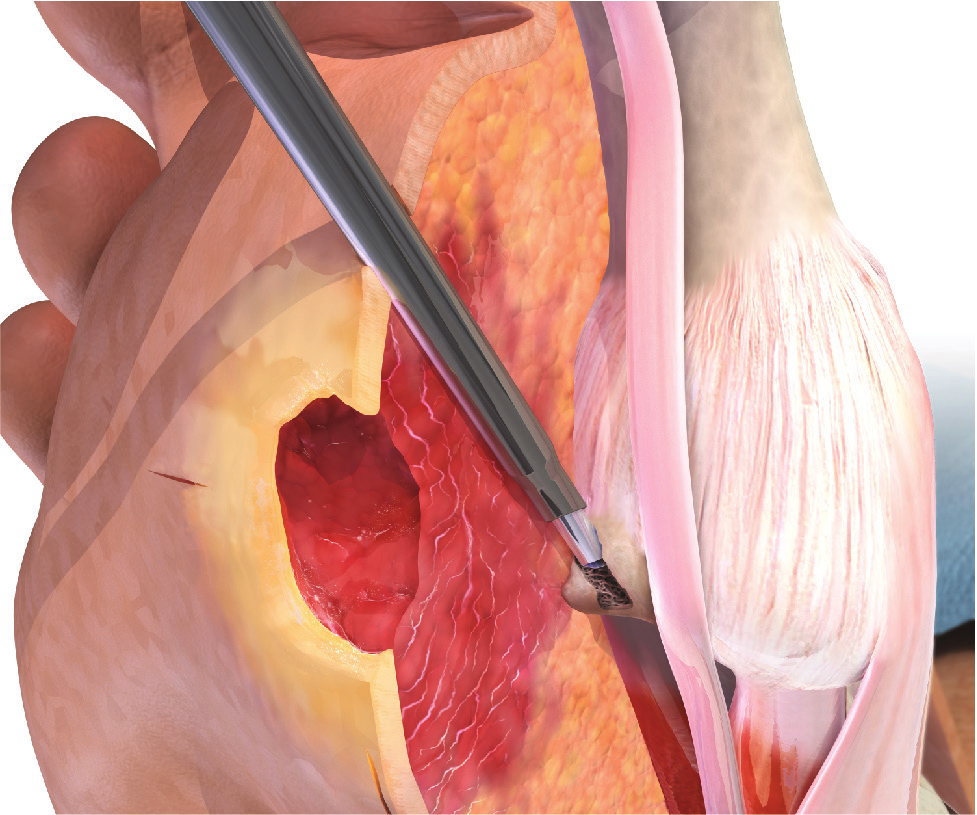 Tenex TX-Bone MicroTip illustration: the tip reaches the bony prominence beneath the ulcer through a small separate incision