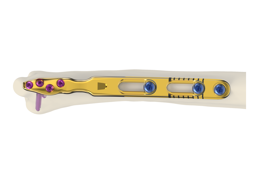 FREEFIX USP ulnar shortening construct on bone — Skeletal Dynamics
