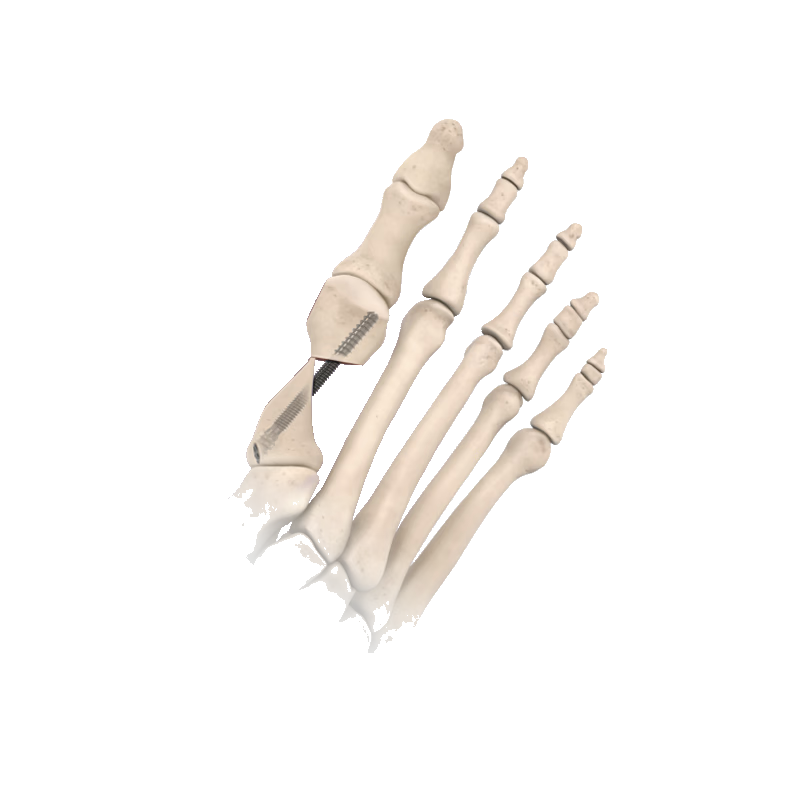 First metatarsal osteotomy with a single screw.